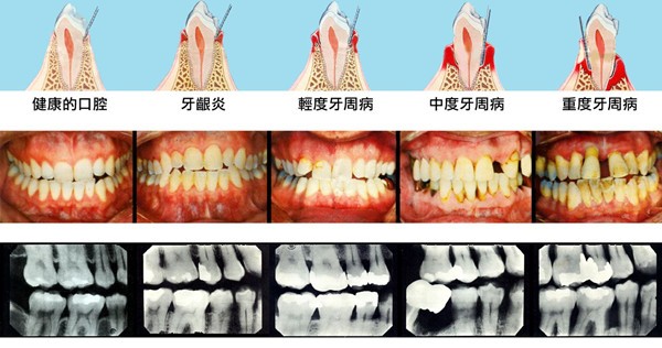 牙周病怎么治疗最有效？湖州哪个口腔医院看牙技术好？