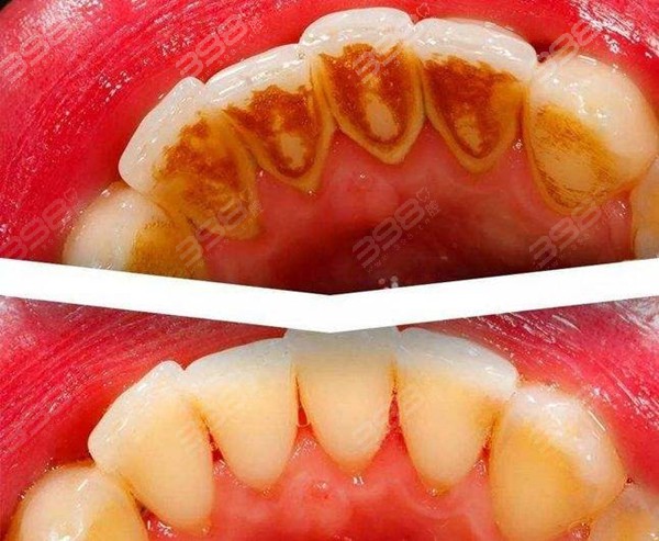 牙周病怎么治疗才有效？