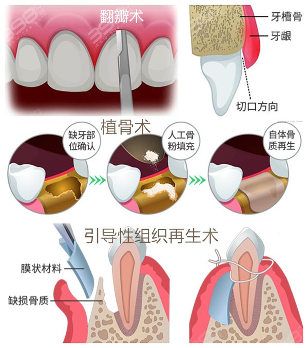牙周病的手术治疗方法