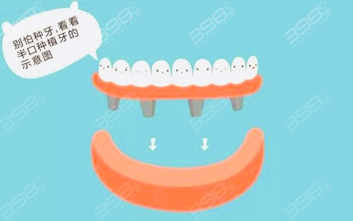 北京东城区种植牙医院和医生有推荐吗？半口种植价格多少