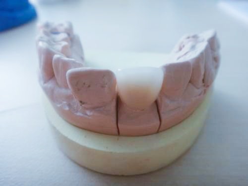 二氧化锆全瓷牙好不好？全瓷牙基牙烂掉的概率有多大？