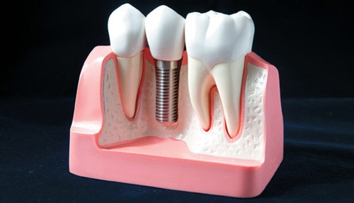 南充哪家种植牙医院好？种牙补骨粉会有风险吗？费用怎样