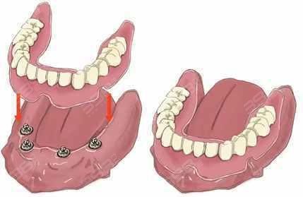 活动义齿与固定义齿的区别
