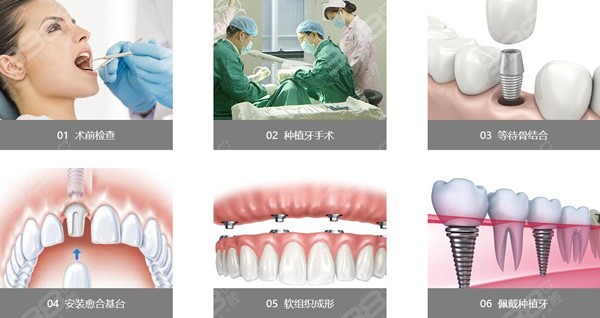 种植牙流程解析：要几次才能完成手术？