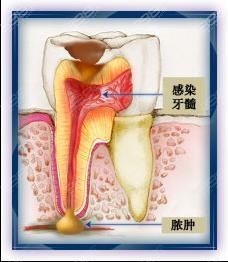 牙齿矫正对牙髓的影响