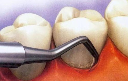 龈下刮治能治好牙周炎吗？对牙龈萎缩有帮助吗？多钱一颗