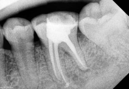 根管治疗做牙套骗局？那是你不知道根管治疗后牙齿的寿命