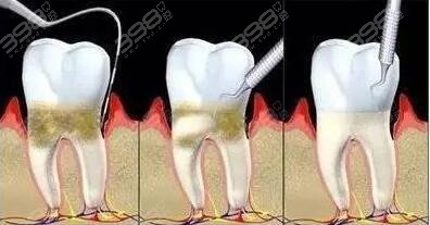 龈下刮治能治好牙周炎吗？
