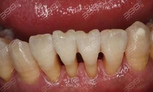 龈下刮治对牙龈萎缩有帮助吗？