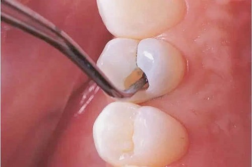 龋齿补牙就是个骗局！树脂补牙会不会越补越烂？维持久吗