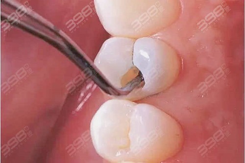龋齿补牙就是个骗局！树脂补牙会不会越补越烂？维持久吗