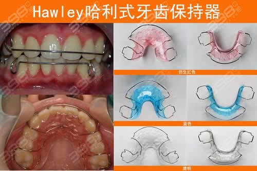 hawley保持器分型图片