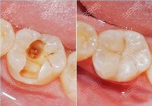 三门峡口腔医院价格表大公开，3M树脂补牙多少钱一颗？