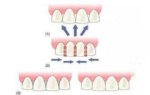 片切牙齿矫正有什么危害？牙齿切片的详解确定不来了解下