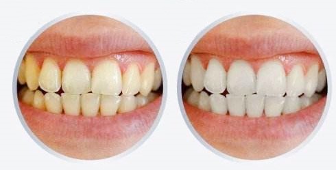 益阳哪里能美白牙齿？冷光牙齿美白能管多久？多少钱？