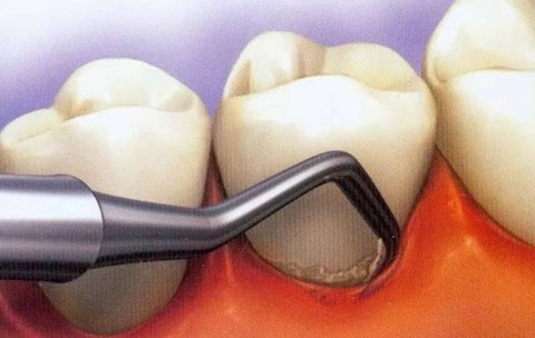 牙周刮治后越来越严重了 这是为什么 到底要不要做龈下刮治