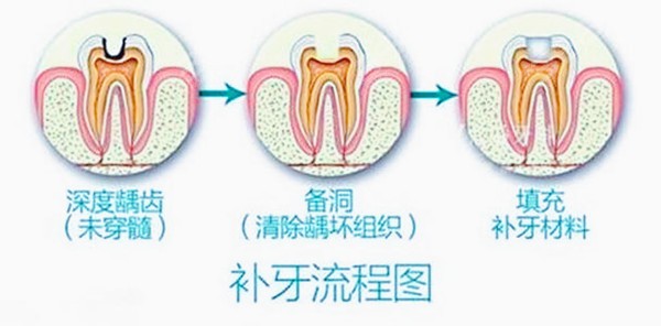 补牙流程