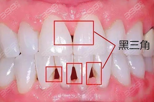 牙齿黑三角怎么办？牙齿矫正会引起黑三角？