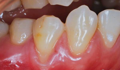 年轻人牙龈萎缩自愈吗？牙根越来越长怎么办？怎么处理？