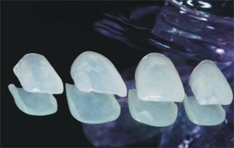 牙贴面能维持多久 如何延长寿命 全瓷贴面大概多少钱一颗？
