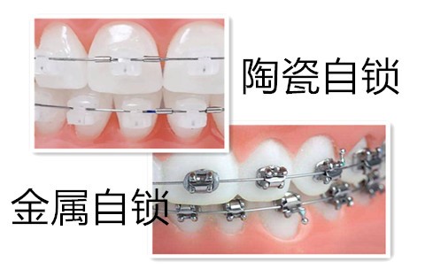 陶瓷和金属自锁的牙套哪个比较好？矫正下需要来多少钱？