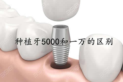 种植牙5000和一万的区别大不大？5000的种植牙能用吗？