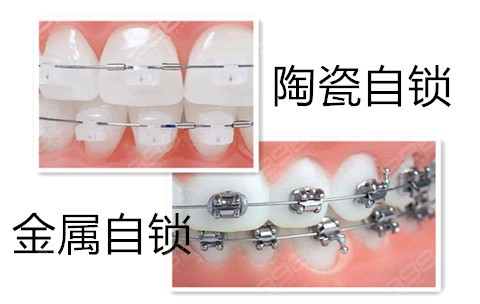 陶瓷和金属自锁的牙套哪个比较好？