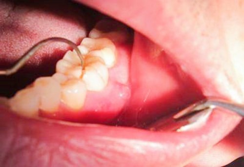 才22岁牙齿就隐裂了，会越来越严重吗？该怎么治疗？