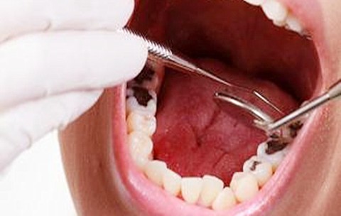 玻璃离子补牙和树脂补牙有什么不一样 儿童补牙适合哪种？