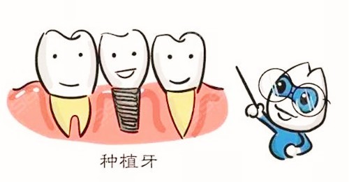 北京哪里种牙便宜又好？5000的种植牙能用几年？质量好吗？