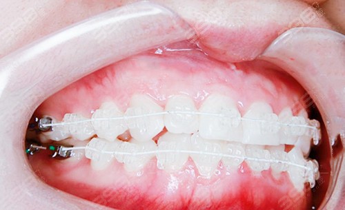 牙齿半隐形矫正效果好吗？