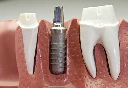贵阳牙科医院排名中最好的是哪家？种牙价格多少钱一颗？