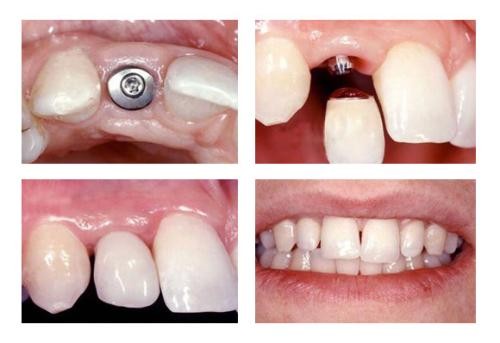 求问：种牙流程有哪些？6000与8000种植牙有什么区别？