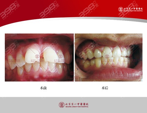 北京东城区牙齿矫正好的医院是哪家？有真人案例吗？