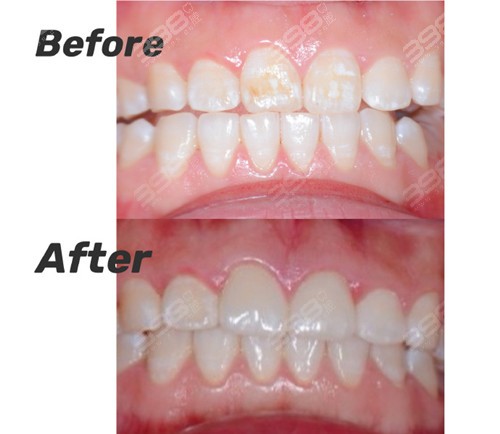 氟斑牙牙齿瓷贴面修复前后对比照