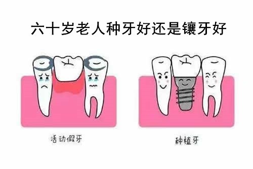 六十岁老人种牙好还是镶牙好？告诉你种植牙与活动义齿的区别
