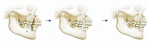 骨性或牙性龅牙矫正可以改善凸嘴吗？侧面也会有改善吧？