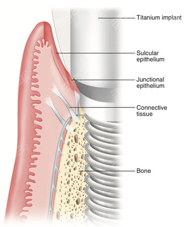 牙槽骨条件示意图