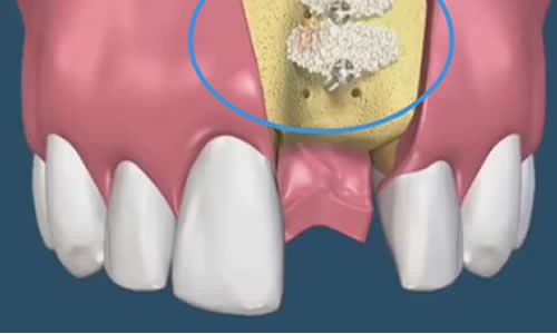 种植牙植入骨粉痛苦？手术是不是很复杂？多长时间能恢复好？