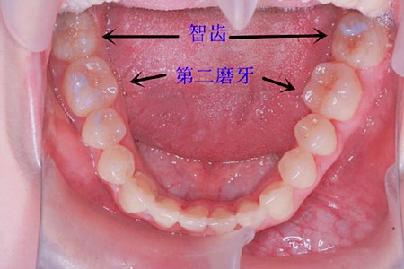 大牙缺失怎么办？智齿前移代替大牙过程靠谱吗？
