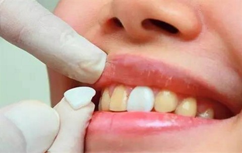 牙齿贴牙片多少钱一颗？牙齿美白需要做多少颗牙齿贴面？