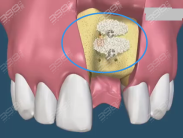 种植牙植入骨粉痛苦？手术是不是很复杂？多长时间能恢复好？