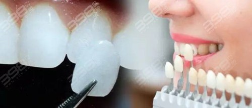 牙齿贴牙片多少钱一颗？