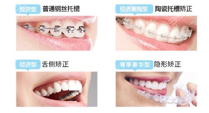 牙套类型有哪些