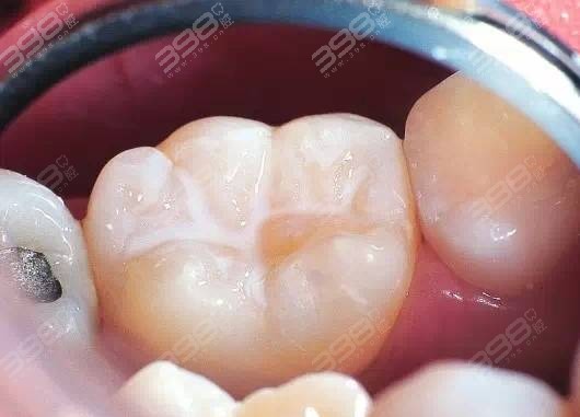 儿童做牙齿窝沟封闭能管几年？