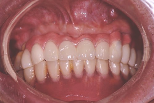 建议镶牙不要种牙是为什么？镶牙和植牙哪个比较好？
