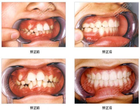 门牙牙根短怎么办？牙根浅的人适合矫正牙齿吗？