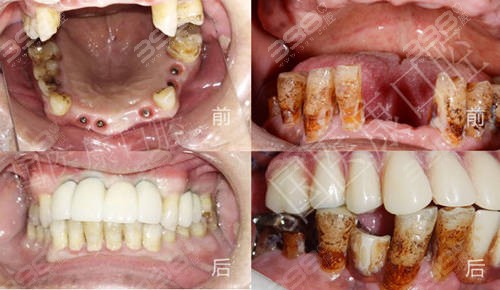 北京哪家口腔医院做老年人种植牙技术好-国医康口腔