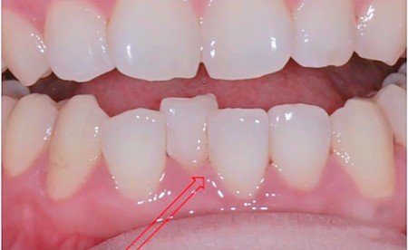为什么牙龈萎缩了就长不出来了？