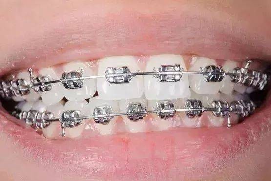 牙套价目表2021：太原牙齿矫正要多少钱？牙齿矫正有哪些方式？